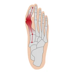 Die moderne Hausfrau Hallux Soft Bandage rechts