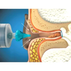 Die moderne Hausfrau Ohrenwachs-Entfernungsspritze